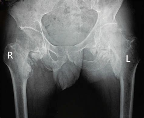 Preoperative Radiographs Of The Pelvis Shows Para Articular Ho On The