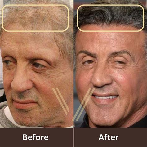 Sylvester Stallone Hair Transplant Before And After Result