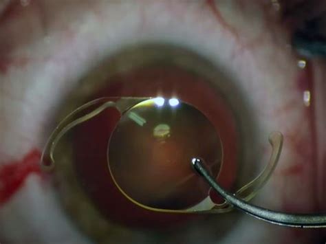 Landing Cataract Surgery