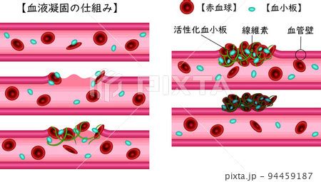 血管凝固の仕組み 日本語 イラストのイラスト素材 94459187 PIXTA