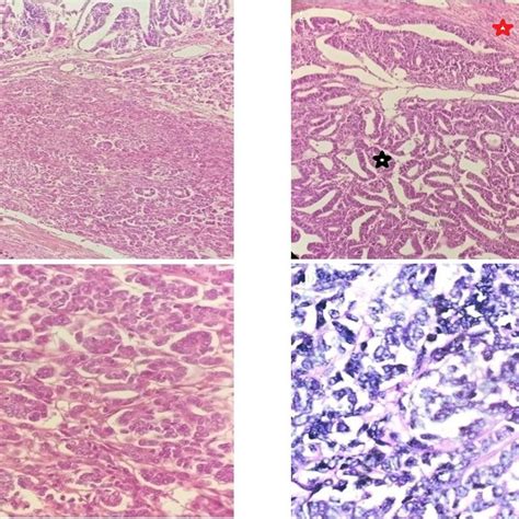 A Histopathological Examination Hpe Of Specimen From First Patient