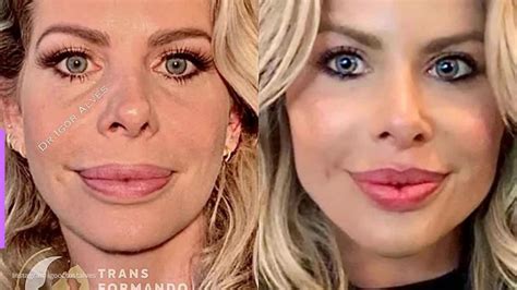 Cirurgião Revela O Antes E Depois De Preenchimento Labial De Karina Bacchi