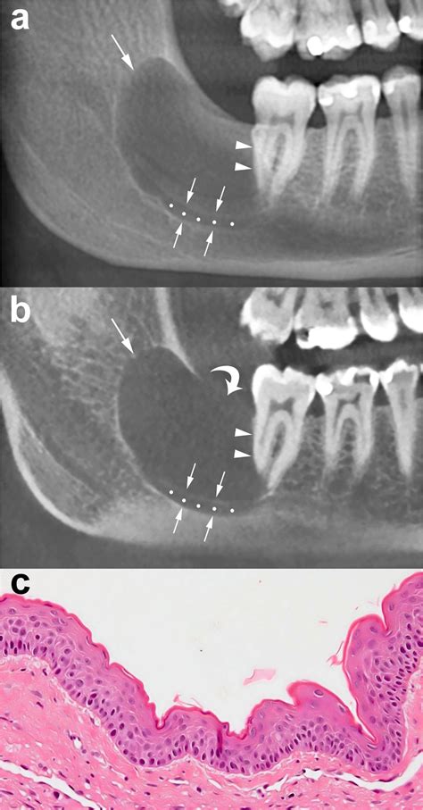 Odontogenic Keratocyst Imaging Features Of A Benign Lesion With An