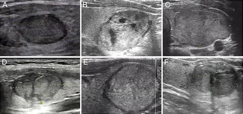 Follicular Adenoma Thyroid Ultrasound