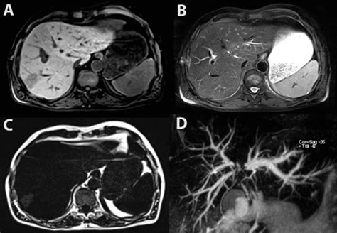 Patient B., 61 years old, Klatskin tumor, status post right ...