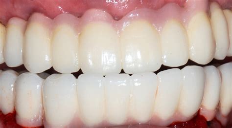 Dental Implants North London, Islington | Best Prices Near Me | 5*