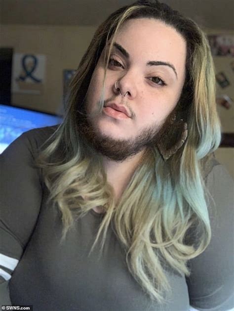 Woman 27 With Excess Facial Hair Caused By Polycystic Ovary Syndrome