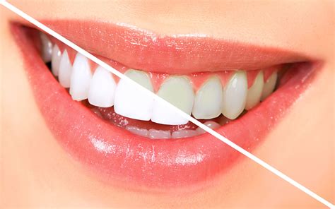 Teeth Whitening Guide To A Beautiful Smile Dentalsreview Abf