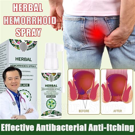 Fast Hemorrhoids Remover Effective Antibacterial Anti Itching Natural