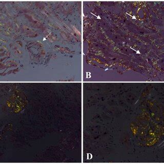 Pattern Of Congo Red Staining Positivity The Amyloid Deposits Show