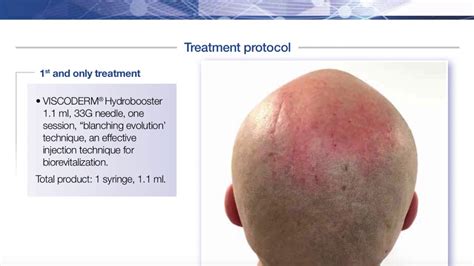 Dr Gabriel Siquier Results Viscoderm Hydrobooster On Scalp Wrinkles