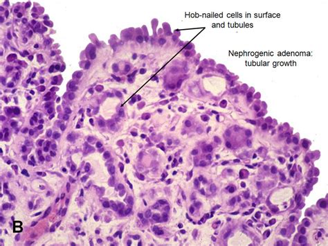 American Urological Association Nephrogenic Adenoma