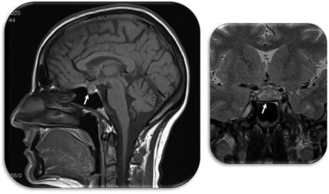 MRI showing pituitary apoplexy and arrows indicating the pituitary ...