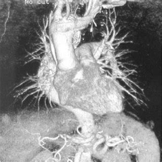 Three Dimensional Angio Ct Reconstruction Of The Patient S Anatomy