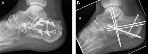 Life After A Calcaneus Fracture Surgery | earth-base