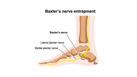 Baxter’s nerve entrapment cortisone injection | Musculoskeletal ...