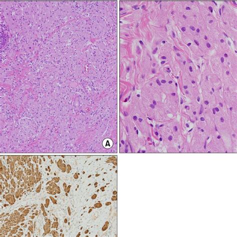 A A Photomicrograph Showing The Tumor Cells Of A Granular Cell Tumor