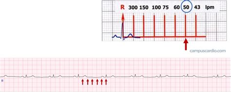 Calcula La Frecuencia Cardíaca En El Siguiente Electrocardiograma