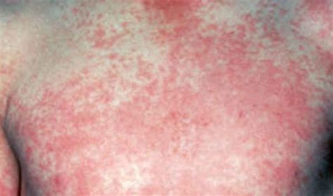 Dengue Rash Images