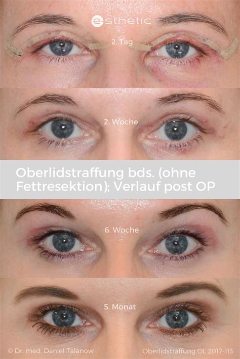 Oberlidstraffung wird in der e sthetic Klinik in Essen sehr häufig