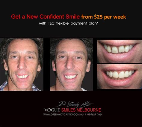 Composite Bonding Resin Veneers Melbourne Cbd