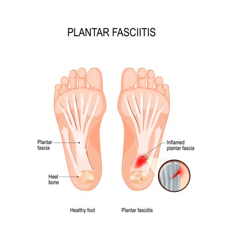 Top 5 Exercises for Plantar Fasciitis — Sarrica