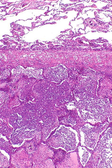 pneumonia libre pathology