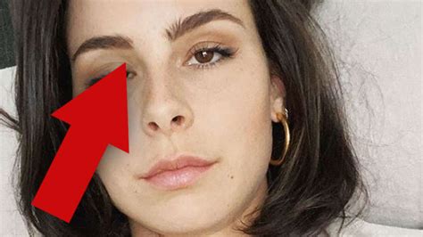 Lena Meyer Landrut Was Ist Mit Ihrem Auge Los Irgendwas Stimmt Da Nicht