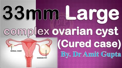 Complex Ovarian Cyst।।33mm Large Right Ovarian Cyst।। Cured Case