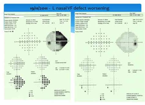 Optic Neuritis - A Case Presentation - Eyedocs