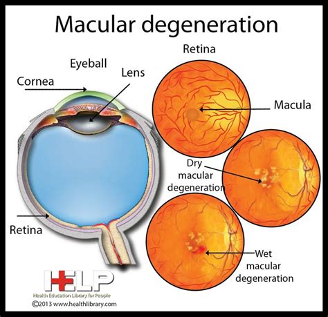 Macula Degeneration Westmead Eyes Optometrists