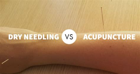 Acupuncture Vs. Dry Needling: Which Is Best For You? | Das Gesundheits Blog