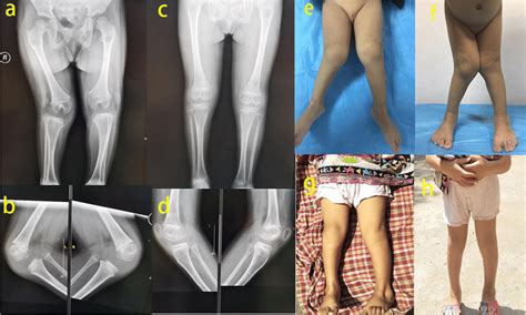 Preoperative And Postoperative Radiographic And Appearance