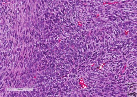 Dermatofibrosarcoma Protuberans Histology