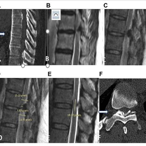 A Mid Sagittal Ct Cuts Showing Associated Spinal Ligament Ossification Download Scientific