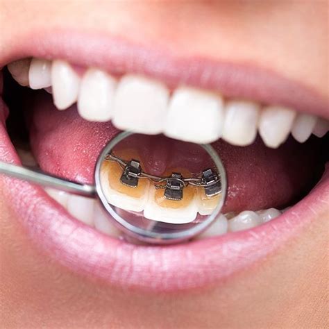 Dental Braces Smile Dental Dental Care Center Lingual Braces