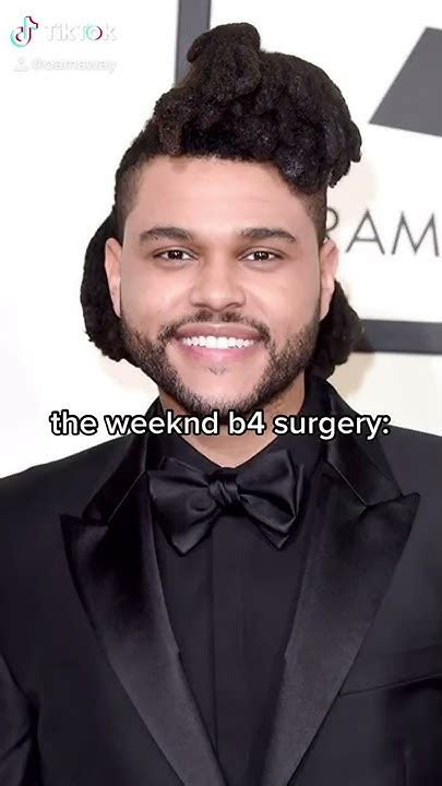 The Weeknd’s Plastic Surgery Before And After Must Watch Tiktok Edition 😭‼️ Read