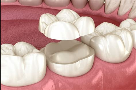 Porcelain Onlay - Atlas Dental, Toronto dentist