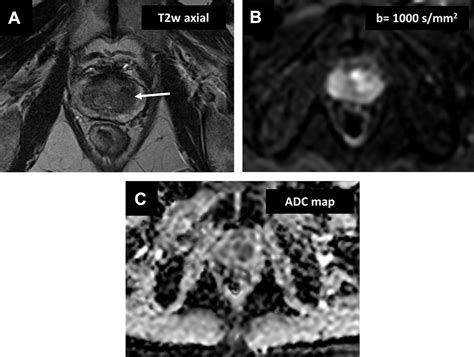 Diffusion Weighted Genitourinary Imaging Urologic Clinics