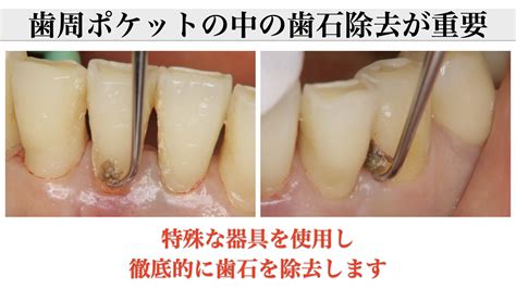 歯周ポケットの奥まで歯石除去してもらっていますか？｜スケーリングルートプレーニング