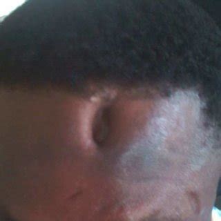 A Year Old Man Who Presented With Depressed Forehead Scar Following