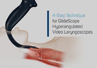 4-step Technique GlideScope Intubation | Verathon