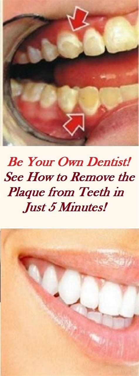 Be Your Own Dentist See How To Remove The Plaque From Teeth In Just 5