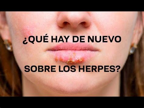 Herpes Labial De Los Mexicanos Est N Infectados C Mo Prevenirlo