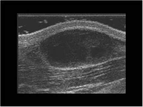 Ultrasound Of Lymph Nodes In Neck