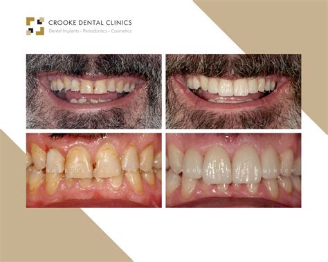 10 Upper And Lower Zirconia Crowns Crooke Dental Clinic