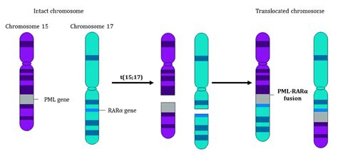 Chromosomal Translocation Between Chromosomes 15 And 17 Acute Download Scientific Diagram