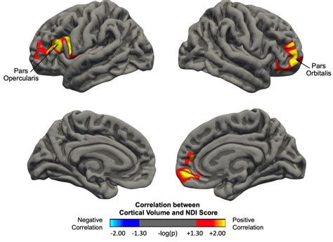 Sex Related Cortical Alterations In Patients With Degenerative