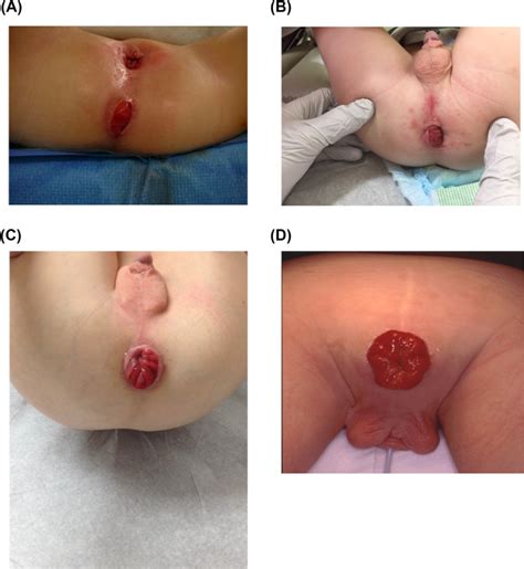 Rectal Prolapse Following Repair Of Anorectal Malformation Incidence