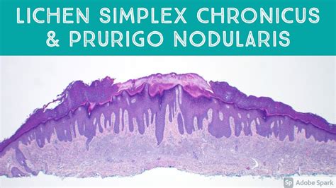 Lichen Simplex Chronicus Histology